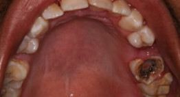 Sâu răng chữa như thế nào an toàn và hiệu quả cao nhất?