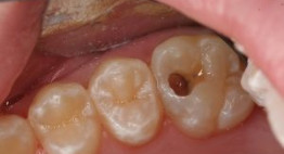 Bệnh sâu răng có chữa được không? – Giải đáp nha khoa