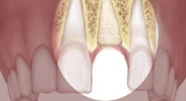 Vì sao nên ghép xương răng trước khi trồng răng implant?