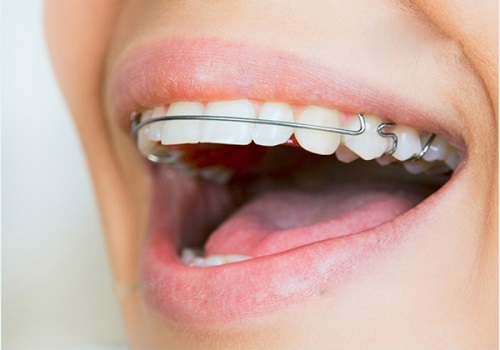 dùng hàm duy trì sau niềng răng 