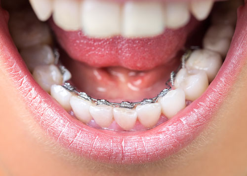 phương pháp niềng răng mắc cài mặt trong 2