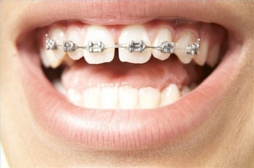 nhổ răng khi niềng răng 2