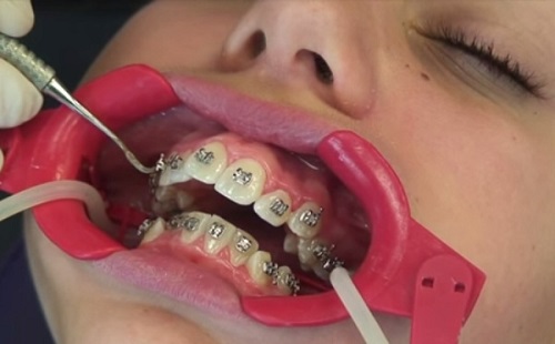 quy trình niềng răng 5