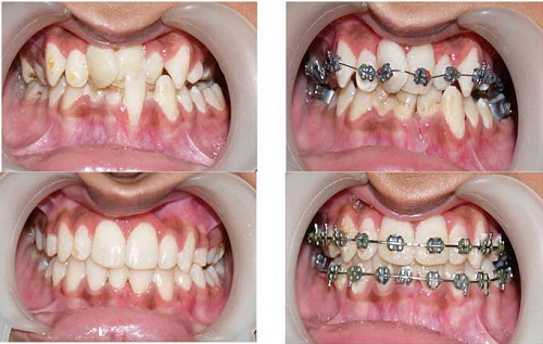 quy trình niềng răng 6
