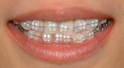 Phương pháp niềng răng thẩm mỹ