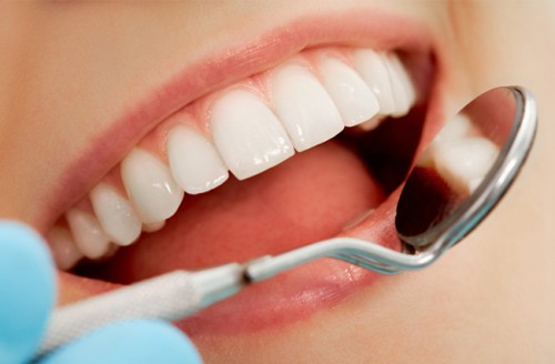 hàm duy trì sau khi niềng răng 2