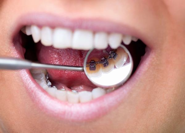 nẹp răng có hại không 2