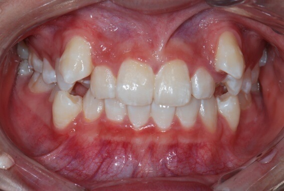 niềng răng khểnh 1