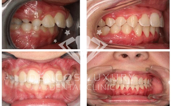 phân biệt hô hàm và hô răng 3