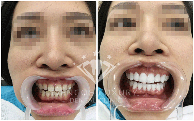 răng thưa và cách khắc phục 3