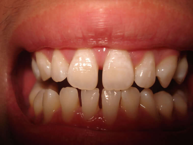 răng thưa và cách khắc phục 