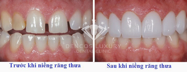 răng thưa và cách khắc phục 2