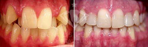 trước và sau khi niềng răng 4