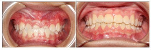 trước và sau khi niềng răng móm