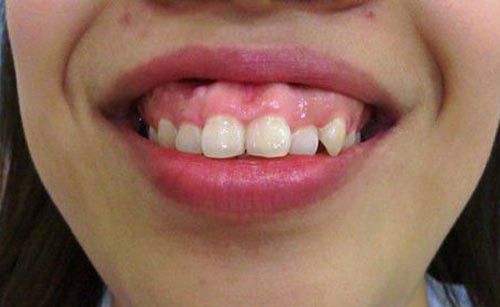 Nguyên nhân gây răng vẩu 1