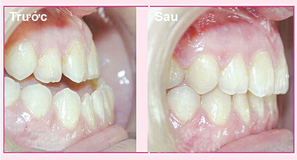 trước và sau khi niềng răng móm