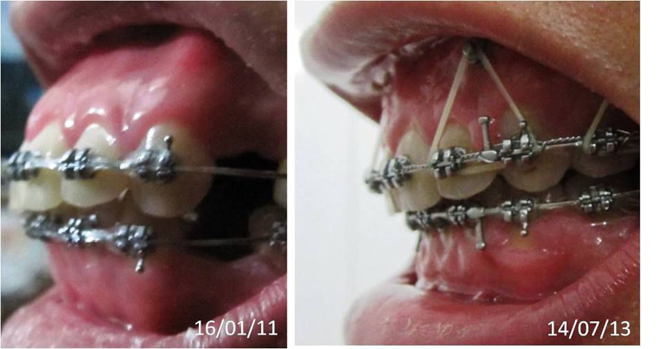 phẫu thuật thẩm mỹ răng vẩu