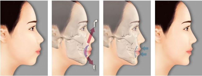 Phẫu thuật hàm hô giá bao nhiêu tiền