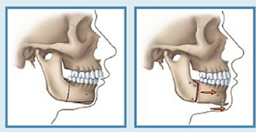 Phẫu thuật hàm hô giá bao nhiêu tiền