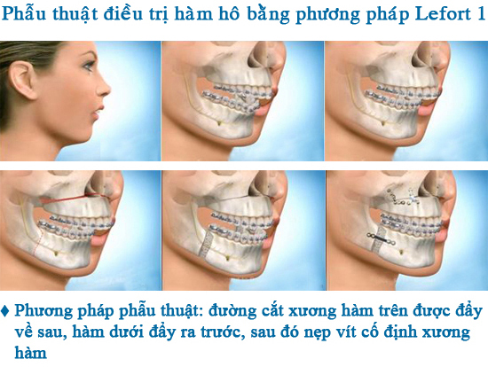 Phẫu thuật hàm hô giá bao nhiêu tiền