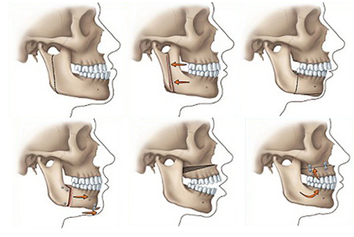 phẫu thuật hàm mặt