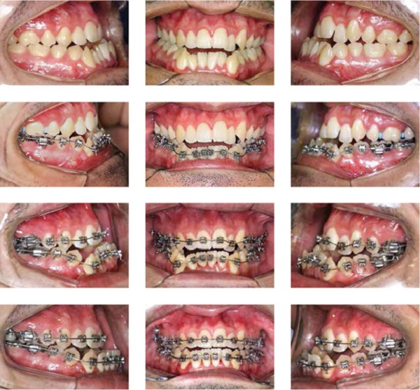 kiến thức về dịch vụ niềng răng 1