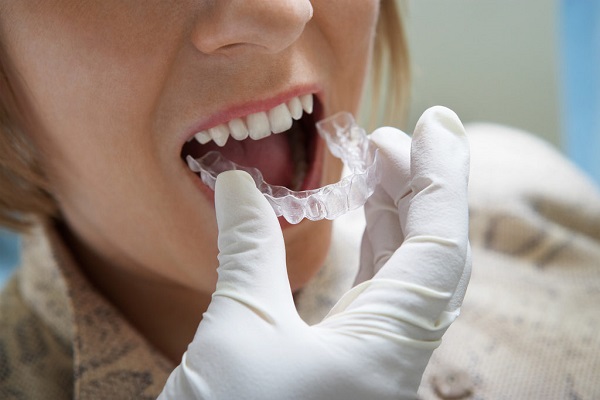 niềng răng bằng nhựa