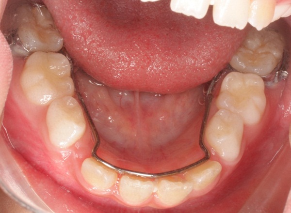  niềng răng hàm dưới