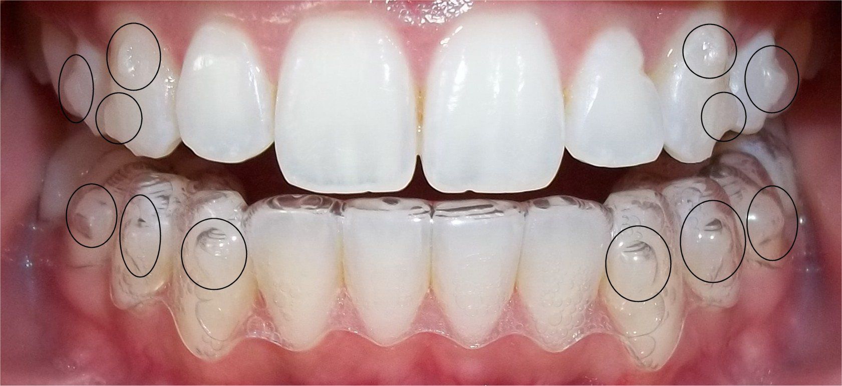 niềng răng không mắc cài eCligner 2
