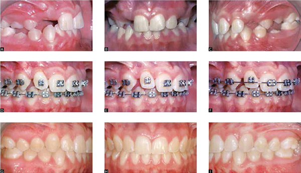 quá trình niềng răng hô 5