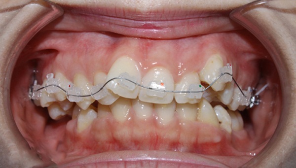 Thẩm mỹ răng 3