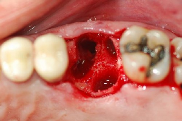 Nhổ răng có nguy hiểm không