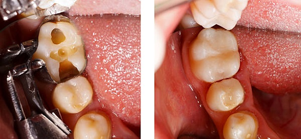 sâu răng có chữa được không 3